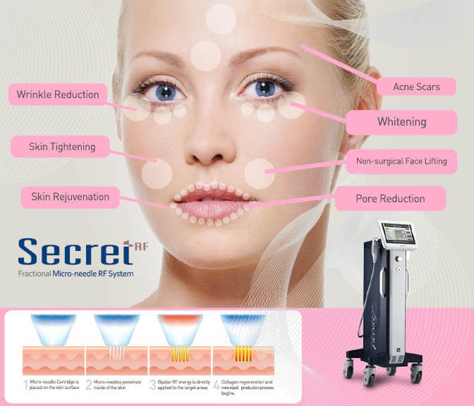 with needles treatment skin Therapy  RF  Skin Radiofrequency Elysium Centre Secret®